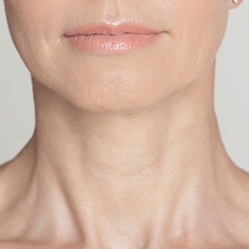 برند مصپورت - کاربرد: رفع باندهای گردن 