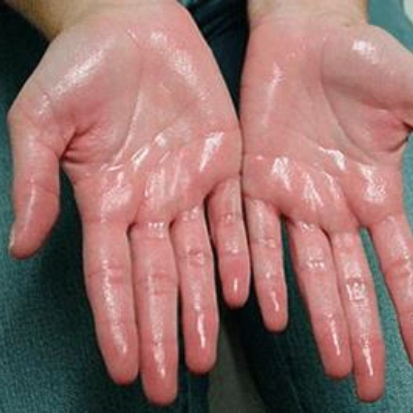 برند مصپورت - رفع تعریق