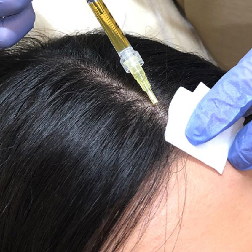 کیت بی دی - درمان ریزش مو - تعداد و فواصل جلسات با توجه به معاینه