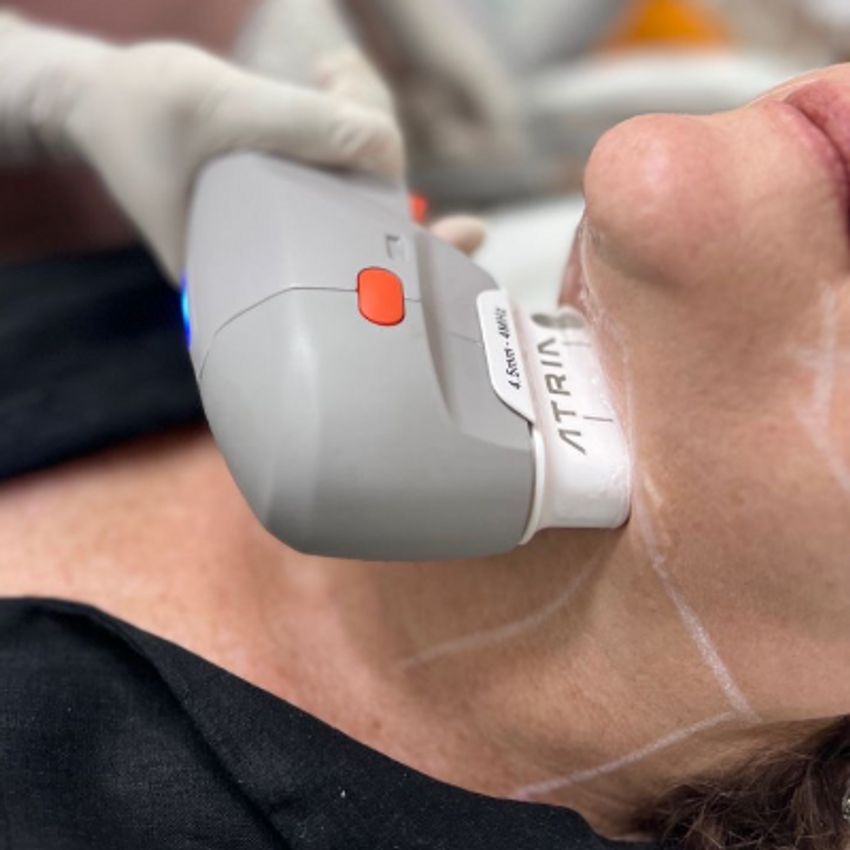 دستگاه هایفو اولترا سه بعدی