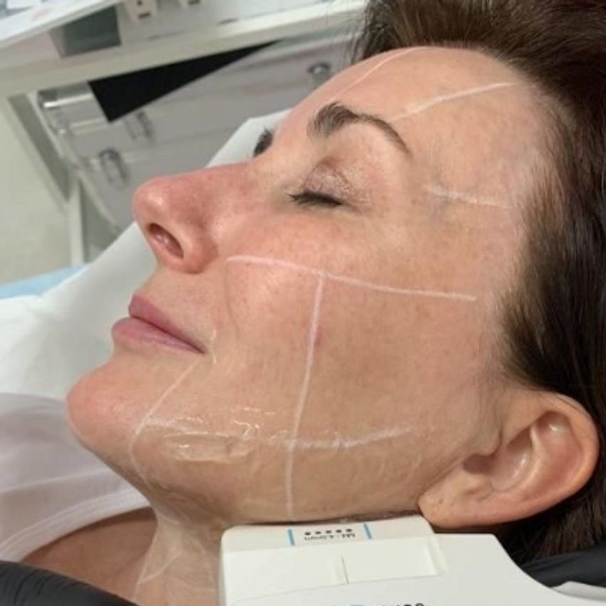 دستگاه هایفو اولترا سه بعدی